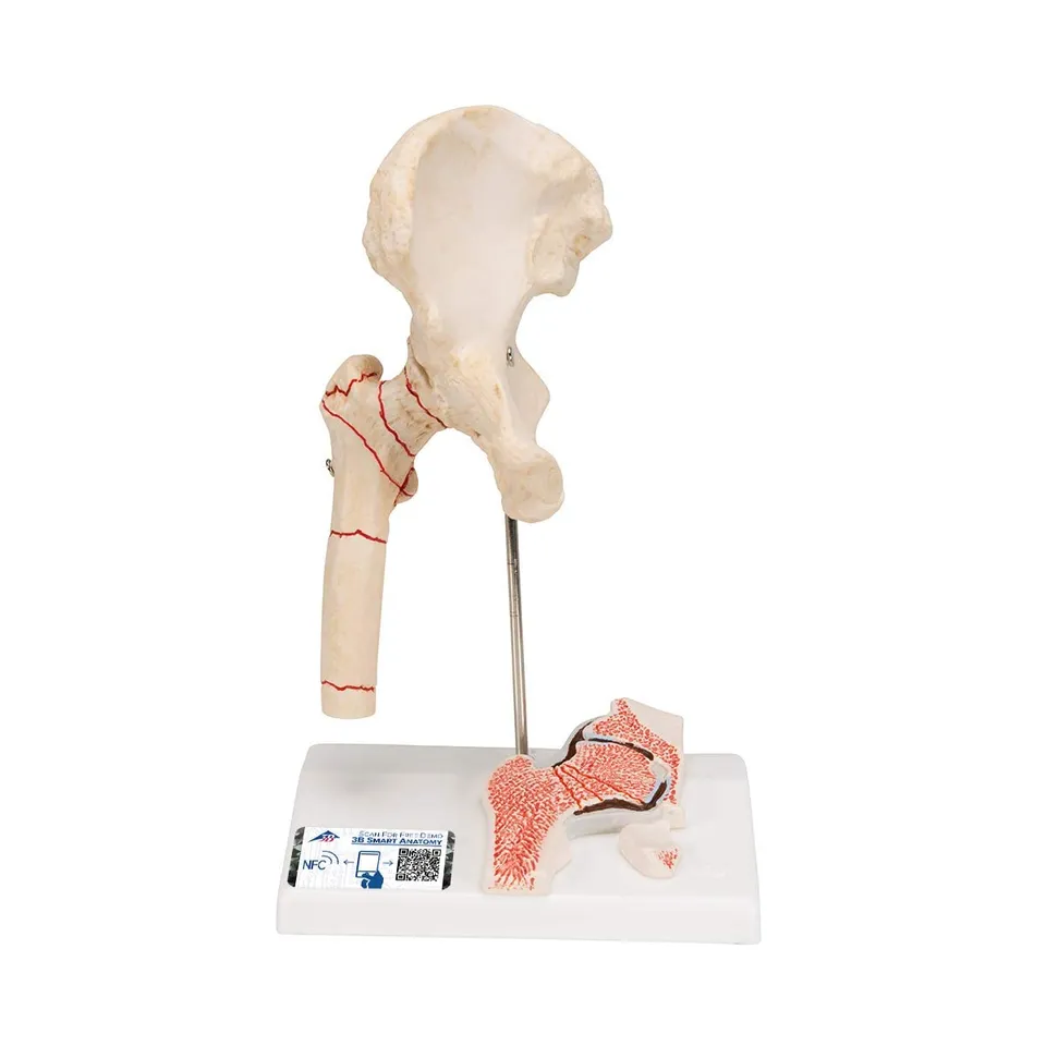 3b-scientific-h-ftgelenkmodell-mit-oberschenkelbruch-und-arthrose-pvc image 1