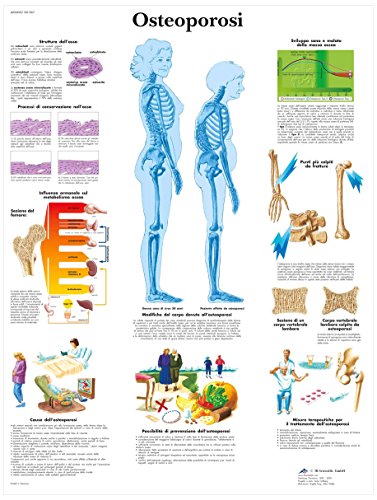 3b-scientific-anatomie-poster-osteoporose-vr4121l-medizinische-lehrtafel image 4