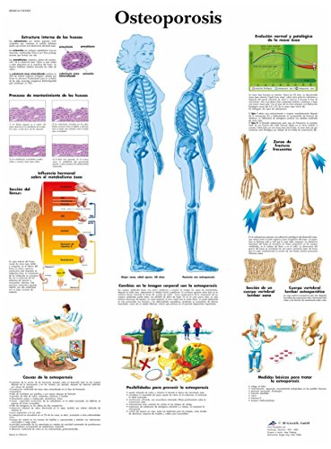 3b-scientific-osteoporose-lehrtafel-papier-50-x-67-cm image 4