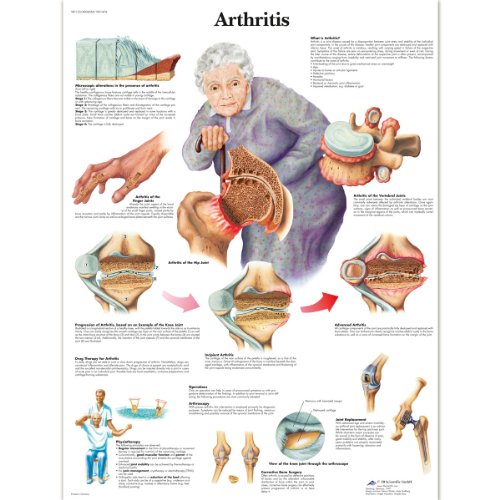 3b-scientific-arthritis-diagramm-laminiert-50-8-x-66-cm-anatomie-lehrtafel image 3