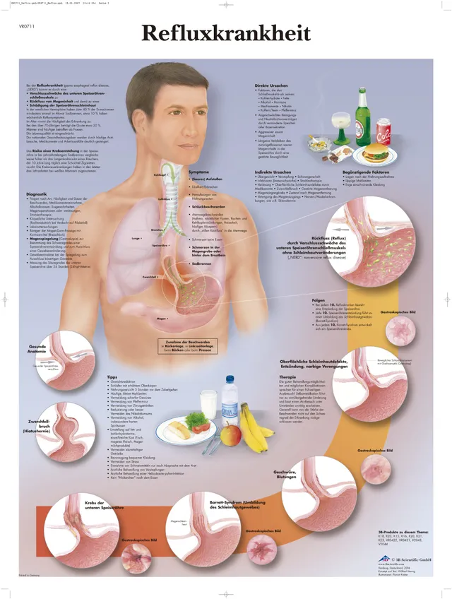 3b-scientific-lehrtafel-refluxkrankheit-anatomie-poster-50x67-cm image 1