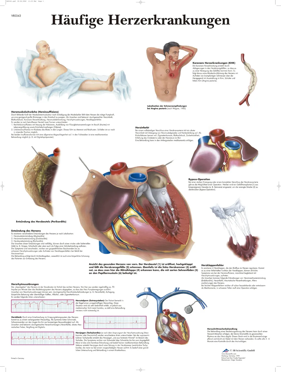 3b-scientific-lehrtafel-h-ufige-herzerkrankungen-laminiertes-poster-50-x-67-cm image 1