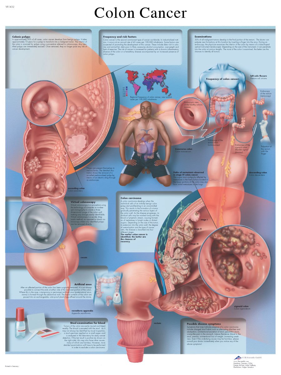 3b-scientific-lehrtafel-darmkrebs-diagramm-50x67-cm-anatomie-poster image 2