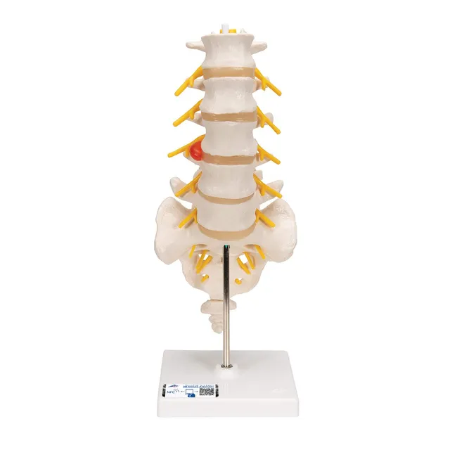 3b-scientific-lendenwirbels-ulenmodell-lebensgro-mit-bandscheibenvorfall-smart-a image 1