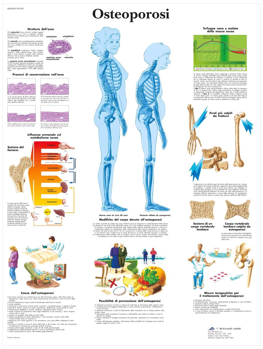 3b-scientific-anatomie-poster-osteoporose-vr4121l-medizinische-lehrtafel image 2