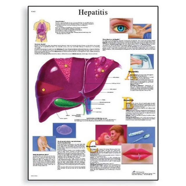 3b-scientific-human-anatomy-hepatitis-lehrtafel-papier-50-x-67-cm image 1