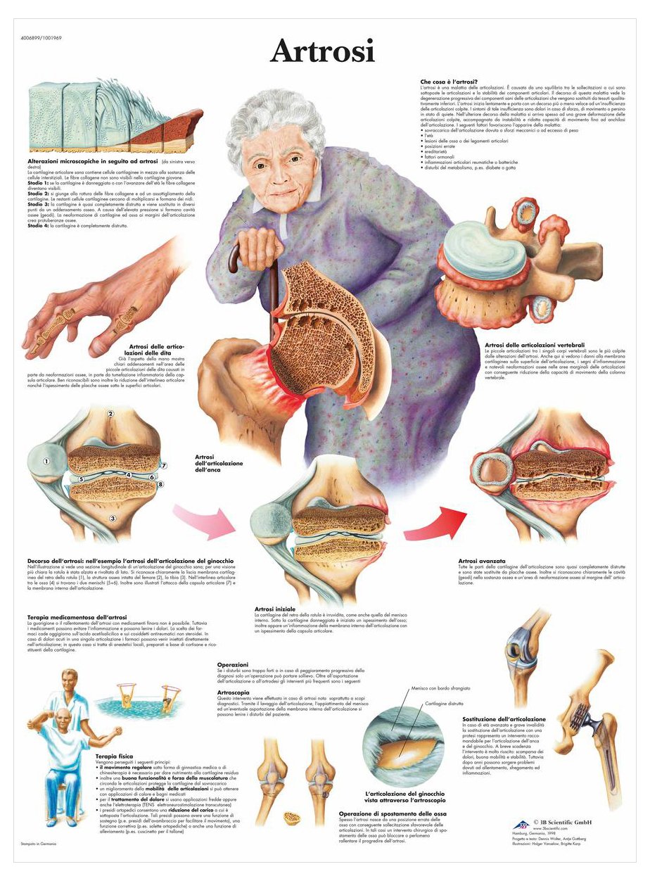 3b-scientific-vr4123l-lehrposter-arthrose image 2