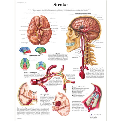 3b-scientific-schlaganfall-tafel-laminiert-50x67-cm-anatomie-pathologie-poster image 3
