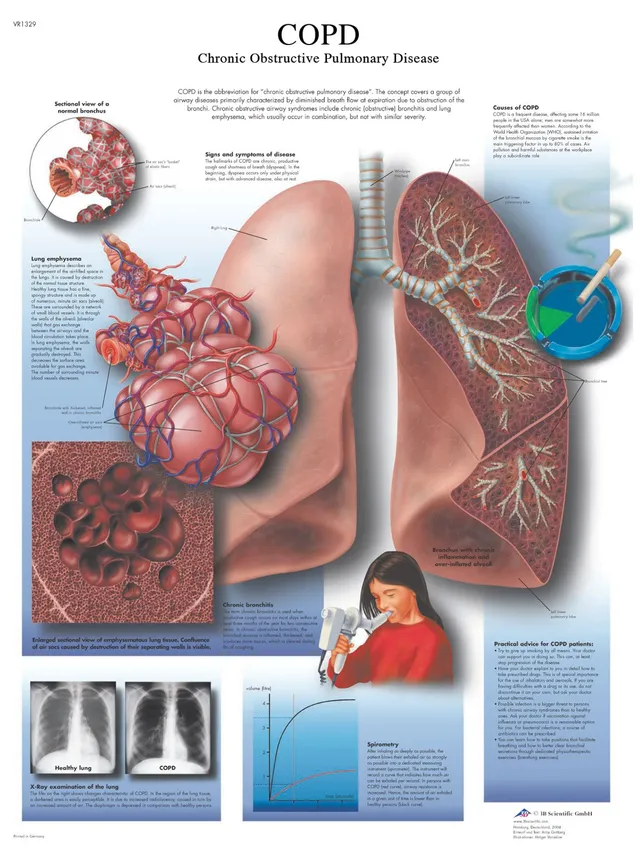 3b-scientific-copd-chronisch-obstruktive-lungenerkrankung-laminierte-lehrtafel-5 image 1