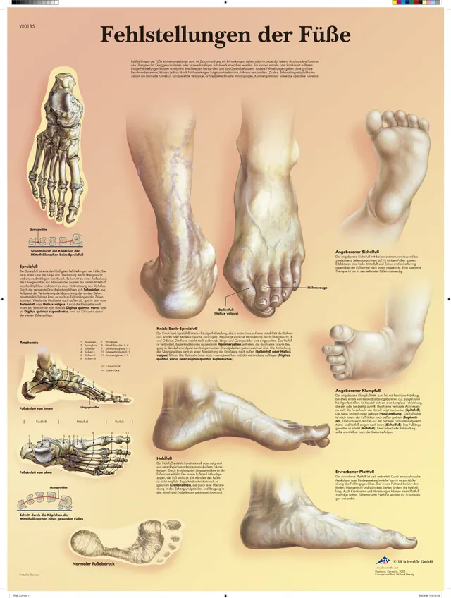 3b-scientific-lehrtafel-fehlstellungen-der-f-e-vr0185l-laminiertes-poster-50x67- image 1