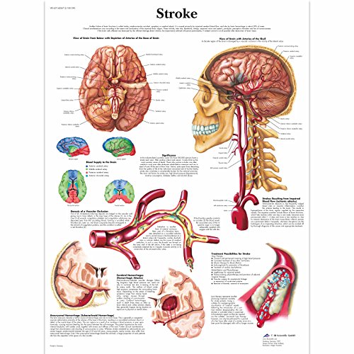 3b-scientific-schlaganfall-tafel-laminiert-50x67-cm-anatomie-pathologie-poster image 4