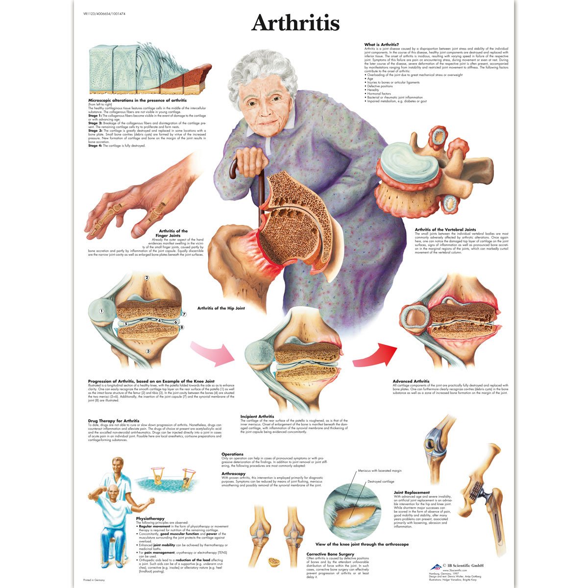 3b-scientific-arthritis-diagramm-laminiert-50-8-x-66-cm-anatomie-lehrtafel image 1