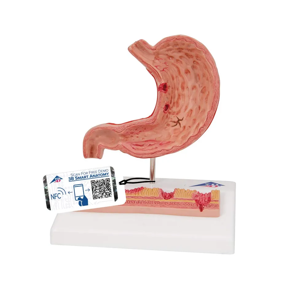 3b-scientific-magenmodell-mit-geschw-ren-humananatomie-modell-aus-pvc-smart-anat image 1