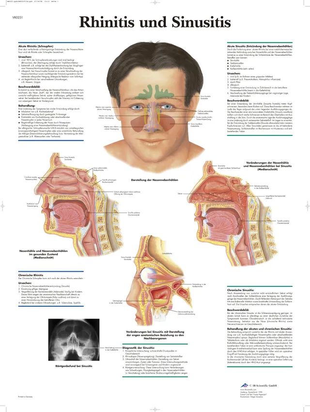3b-scientific-lehrtafel-rhinitis-und-sinusitis-laminiertes-anatomie-poster-50x67 image 1