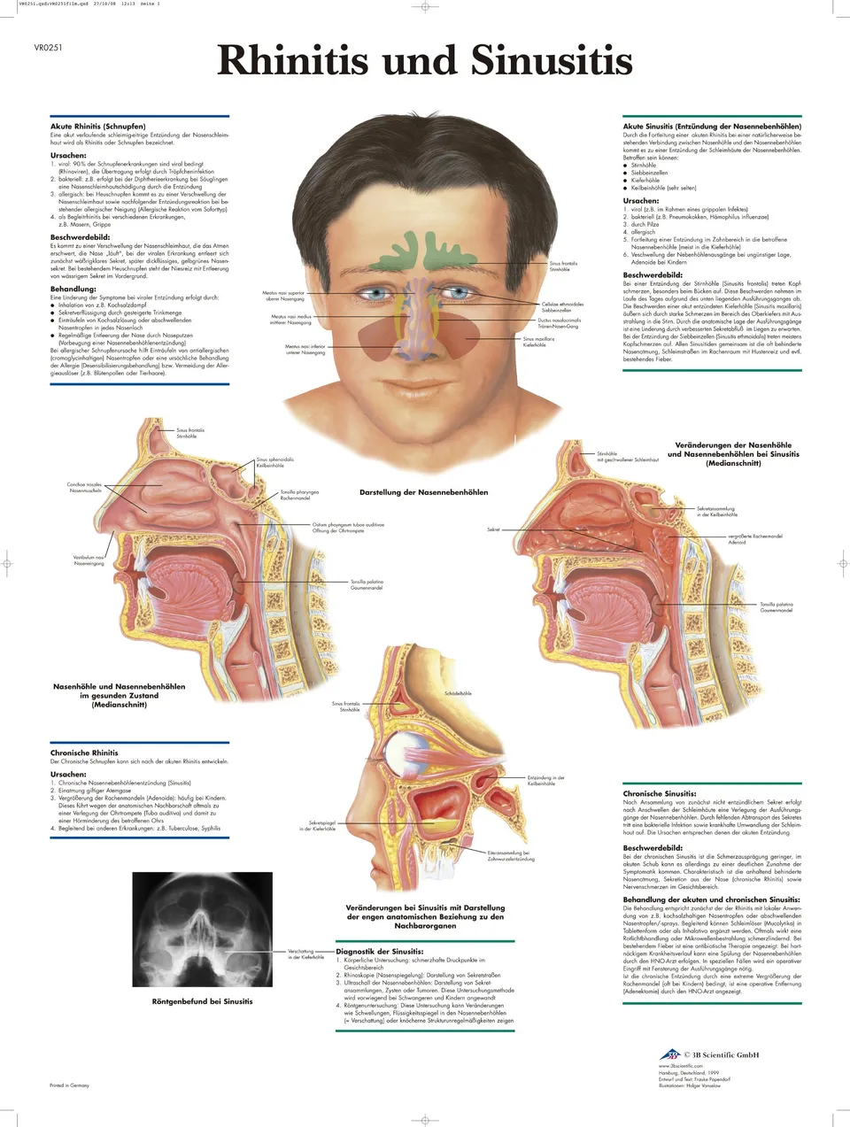 3b-scientific-lehrtafel-rhinitis-und-sinusitis-laminiertes-anatomie-poster-50x67 image 1