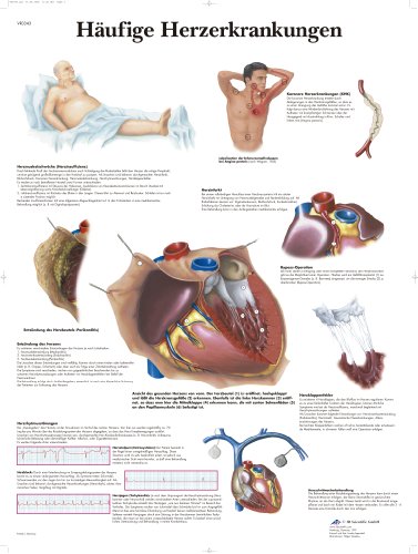 3b-scientific-lehrtafel-h-ufige-herzerkrankungen-laminiertes-poster-50-x-67-cm image 2