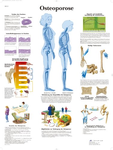 3b-scientific-lehrtafel-osteoporose-vr0121l-laminiert-50x67-cm image 2
