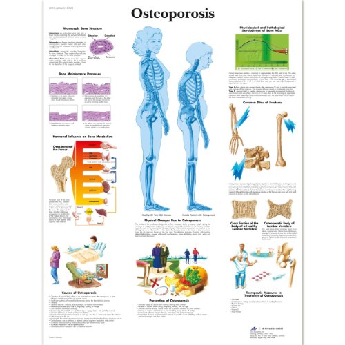 3b-scientific-osteoporose-diagramm-laminiert-50-8-x-66-cm-anatomie-lehrposter image 3