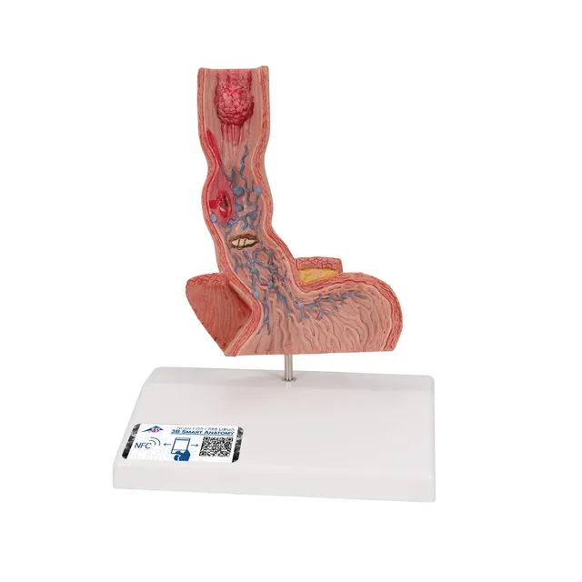 3b-scientific-erkrankungen-der-speiser-hre-pathologiemodell image 1