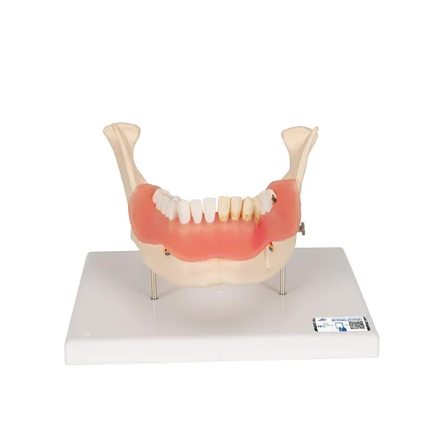 3b-scientific-zahnerkrankungsmodell-2-fach-vergr-ert-21-teilig-smart-anatomy-app image 1