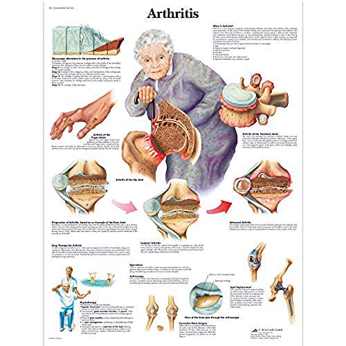 3b-scientific-arthritis-diagramm-laminiert-50-8-x-66-cm-anatomie-lehrtafel image 4