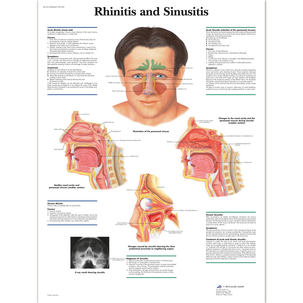 3b-scientific-lehrposter-rhinitis-und-sinusitis-diagramm-poster-50-x-67-cm image 2