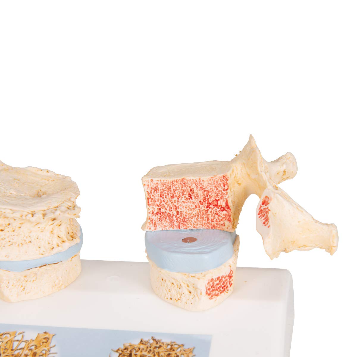 3b-scientific-osteoporosemodell-brustwirbel-vergleichsmodell-gesund-vs-osteoporo image 8