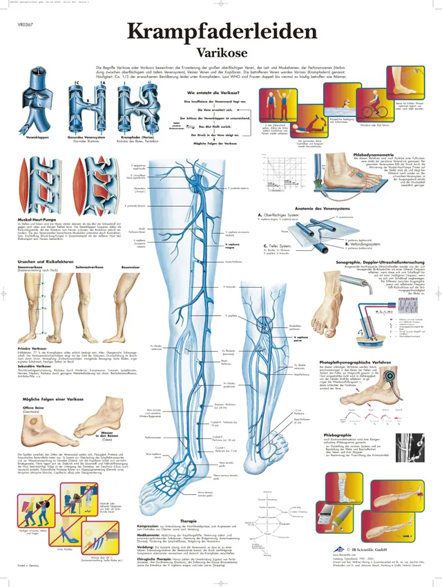 3b-scientific-lehrtafel-krampfaderleiden-varikose-anatomie-poster-50-x-67-cm image 1