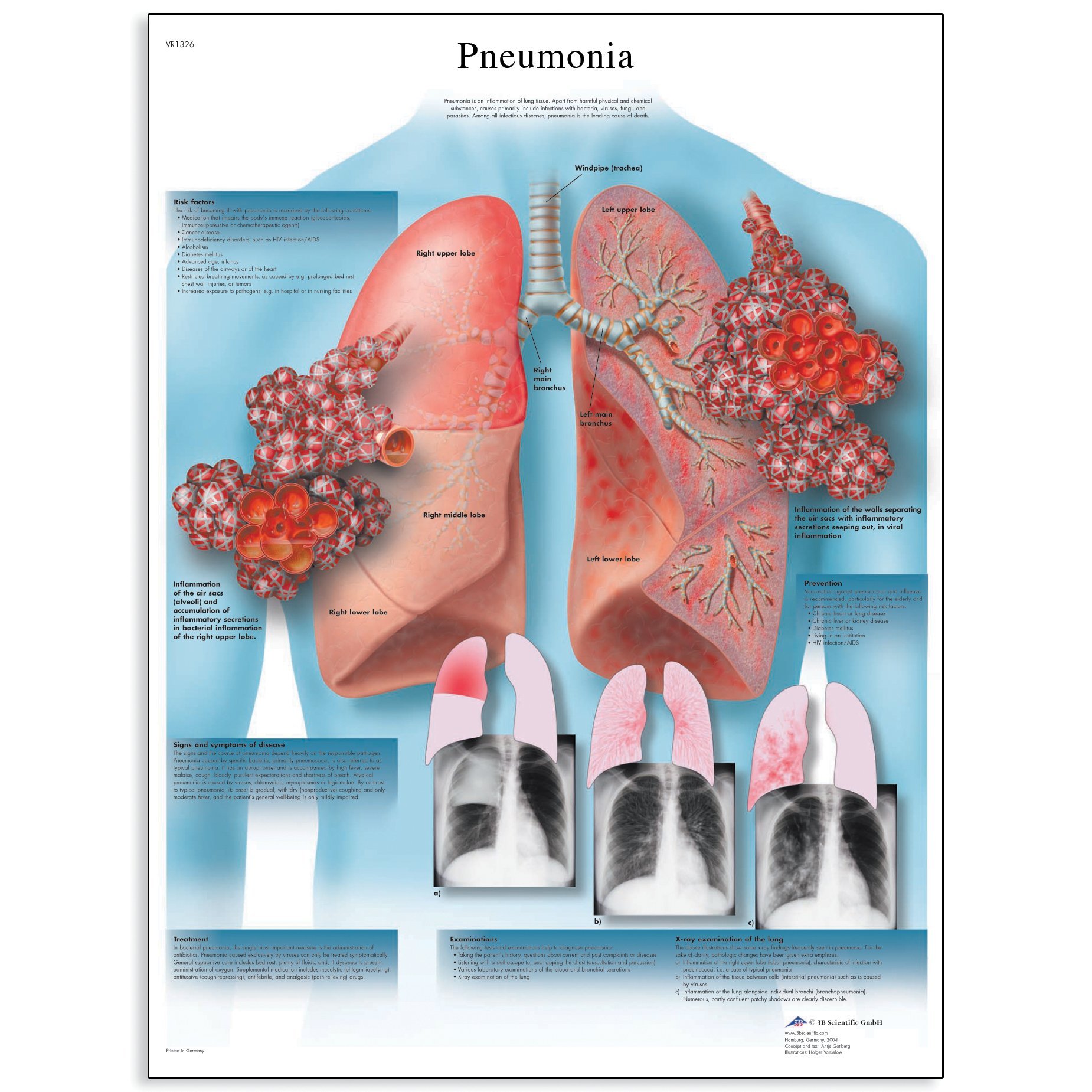3b-scientific-lungenentz-ndung-schaubild-anatomie-poster-50-x-67-cm-200-g-glanz image 1