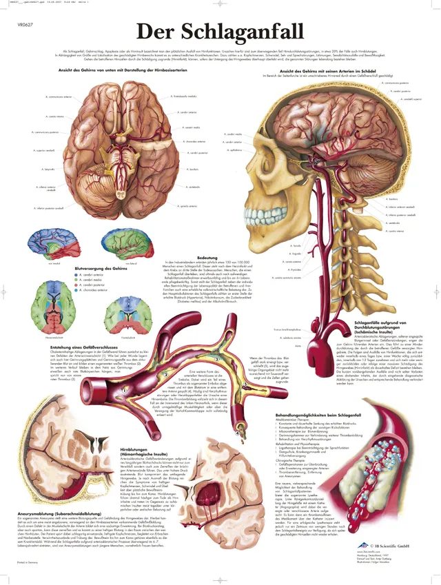 3b-scientific-lehrtafel-der-schlaganfall-anatomieposter-50x67-cm-laminiert image 1