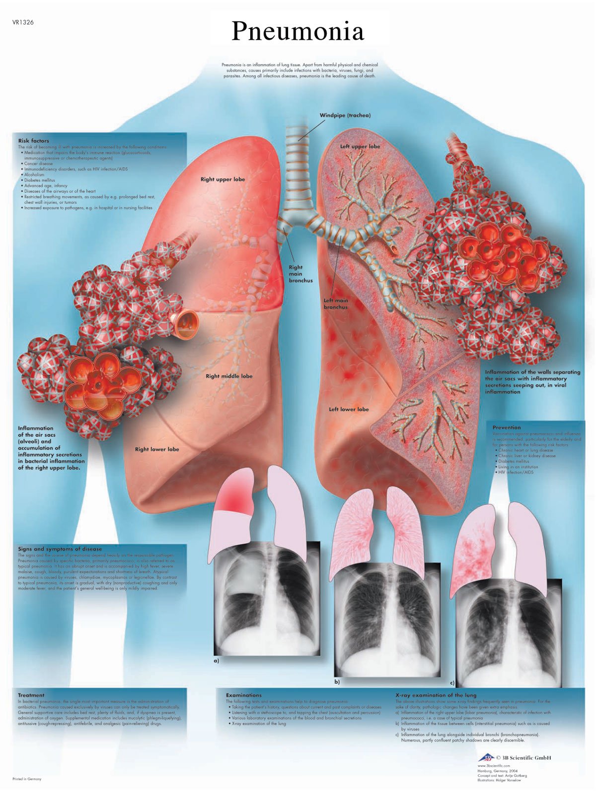 3b-scientific-lungenentz-ndung-schaubild-anatomie-poster-50-x-67-cm-200-g-glanz image 2
