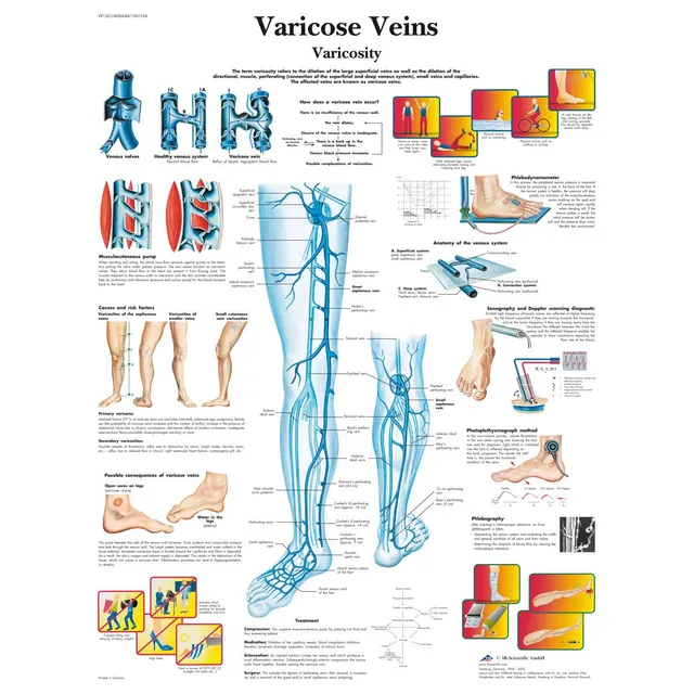 3b-scientific-lehrtafel-varicose-veins-englisch-laminiert-50-x-67-cm image 1