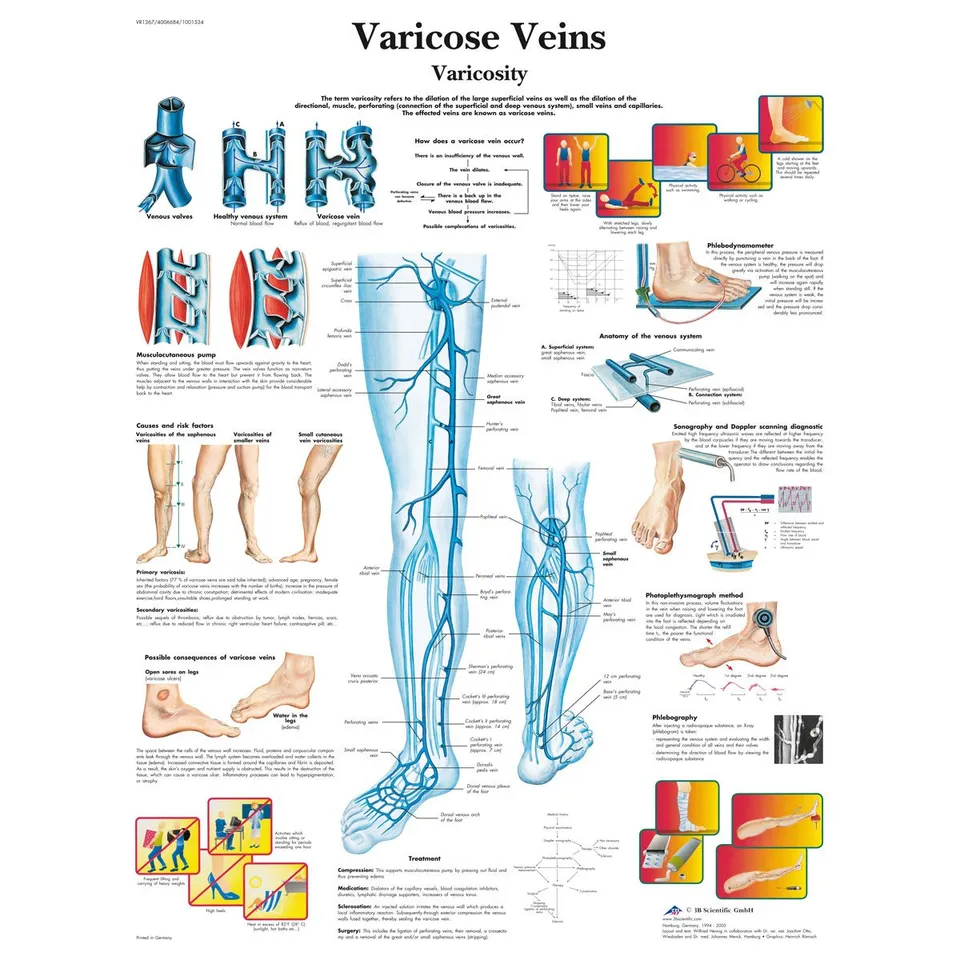 3b-scientific-lehrtafel-varicose-veins-englisch-laminiert-50-x-67-cm image 1