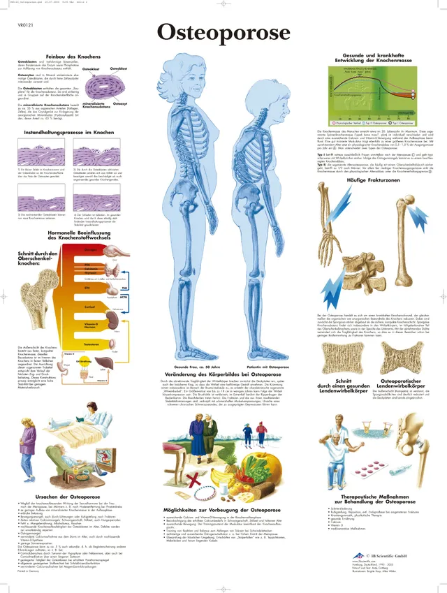 3b-scientific-lehrtafel-osteoporose-vr0121l-laminiert-50x67-cm image 1