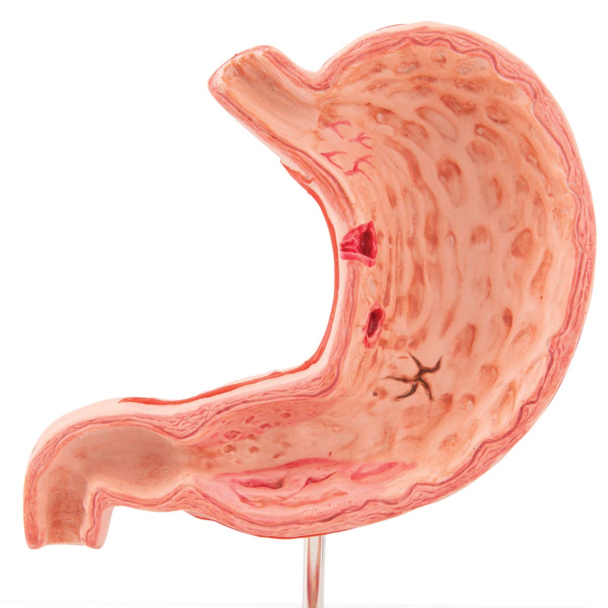 3b-scientific-magenmodell-mit-geschw-ren-humananatomie-modell-aus-pvc-smart-anat image 7