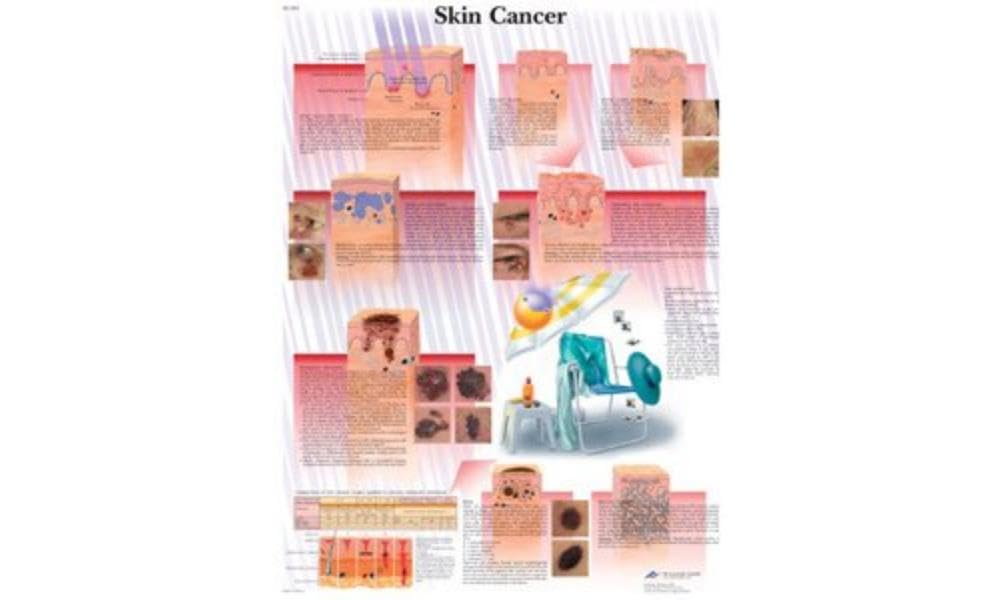 3b-scientific-hautkrebs-diagramm-laminiert-50-x-67-cm-anatomie-lehrtafel-haut image 2