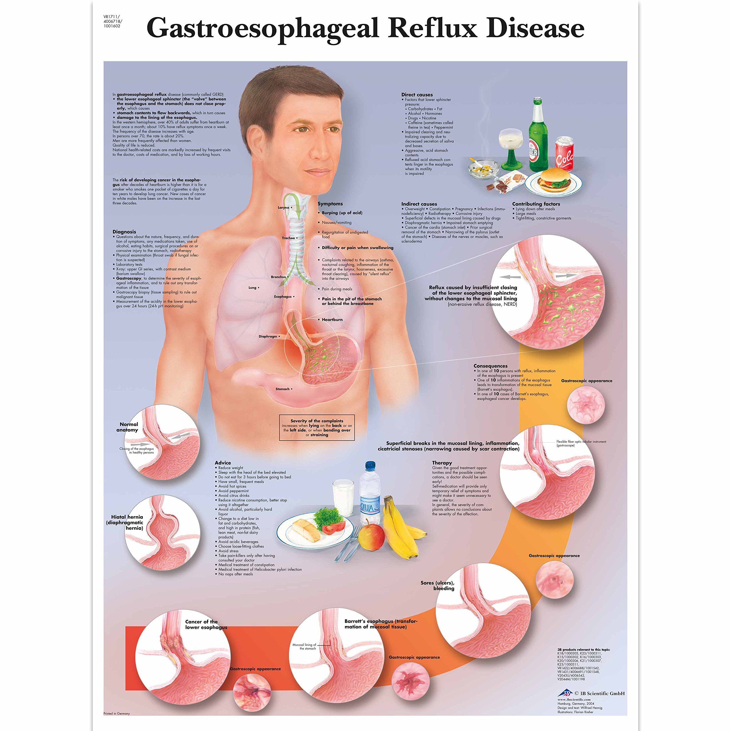 3b-scientific-chart-gastro-sophageale-refluxkrankheit-anatomie-poster-50x67-cm-p image 1