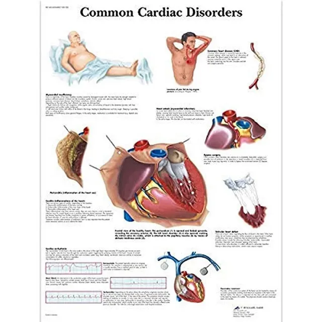 3b-scientific-lehrposter-h-ufige-herzerkrankungen-diagramm-poster-50-x-67-cm image 1
