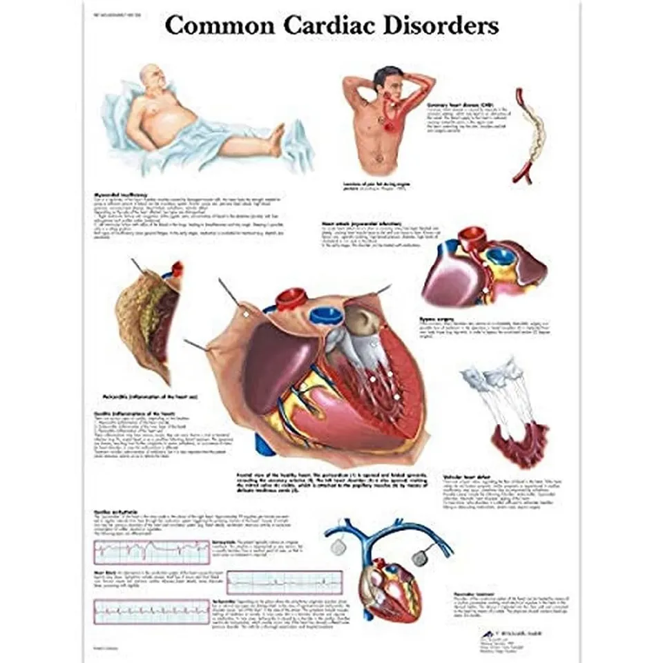 3b-scientific-lehrposter-h-ufige-herzerkrankungen-diagramm-poster-50-x-67-cm image 1