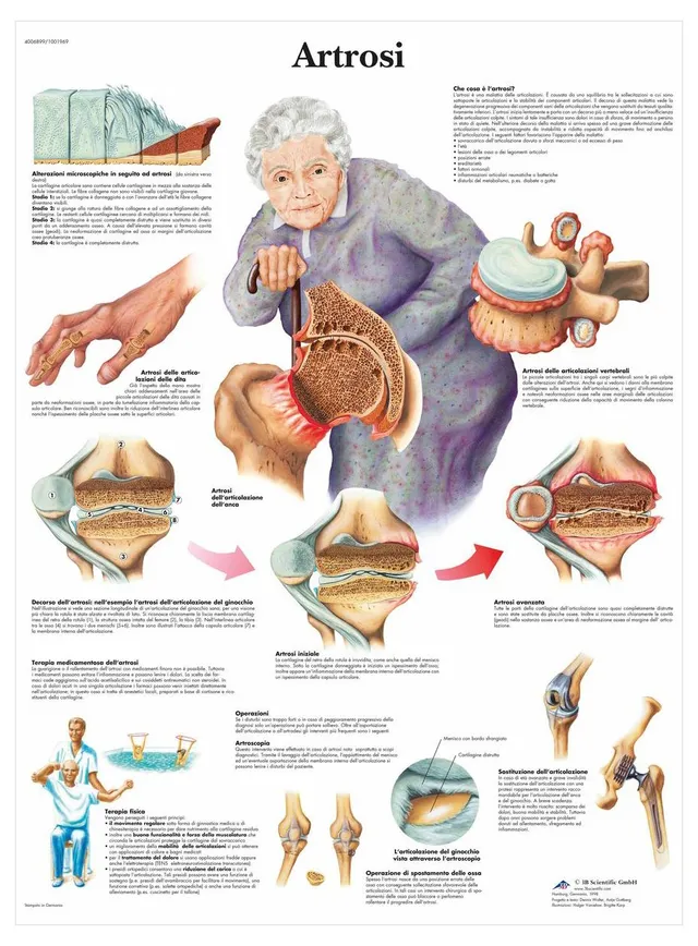 3b-scientific-vr4123l-lehrposter-arthrose image 1