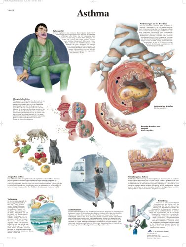 3b-scientific-lehrtafel-asthma-anatomie-poster-50-x-67-cm image 2