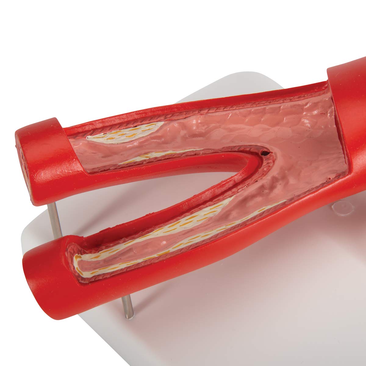 3b-scientific-arteriosklerose-modell-2-teilig-arterien-querschnitt-gesund-erkran image 8