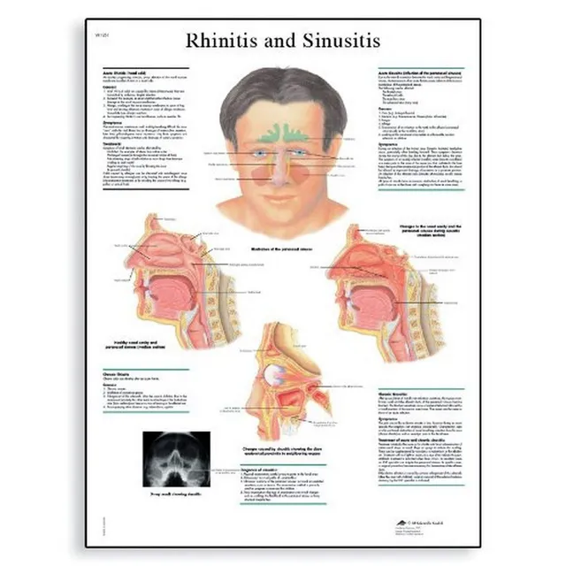 3b-scientific-lehrposter-rhinitis-und-sinusitis-diagramm-poster-50-x-67-cm image 1