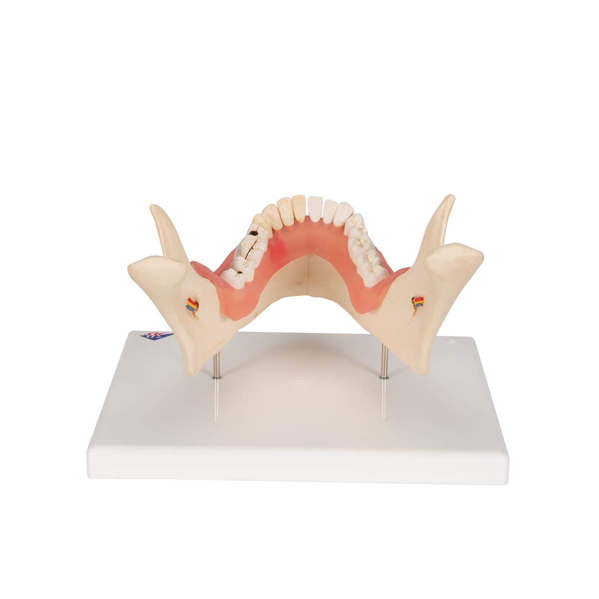 3b-scientific-zahnerkrankungsmodell-2-fach-vergr-ert-21-teilig-smart-anatomy-app image 2