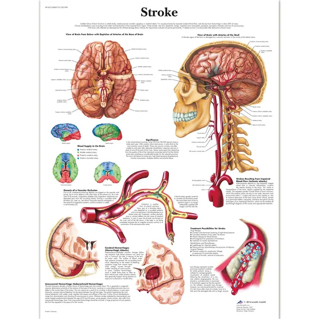 3b-scientific-schlaganfall-tafel-laminiert-50x67-cm-anatomie-pathologie-poster image 1