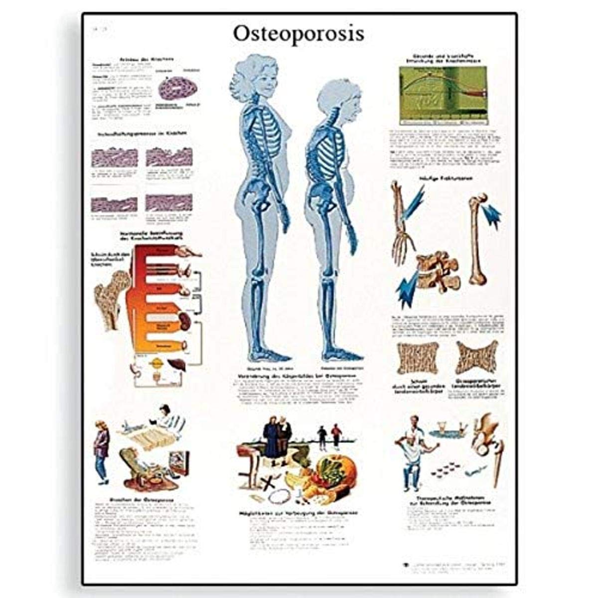 3b-scientific-osteoporose-diagramm-laminiert-50-8-x-66-cm-anatomie-lehrposter image 2