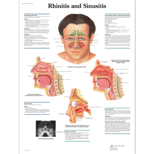 3b-scientific-lehrposter-rhinitis-und-sinusitis-diagramm-poster-50-x-67-cm image 4