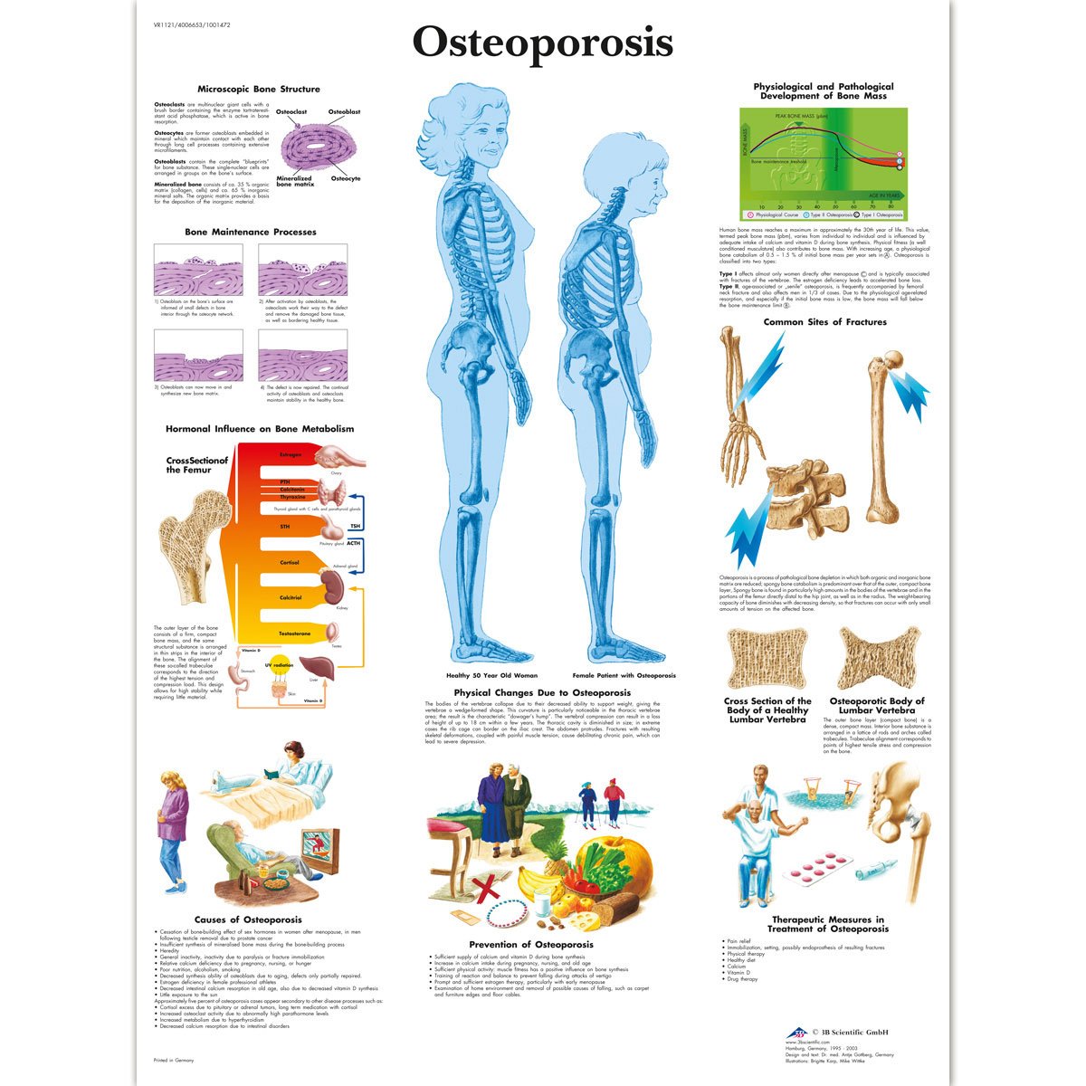 3b-scientific-osteoporose-diagramm-laminiert-50-8-x-66-cm-anatomie-lehrposter image 1