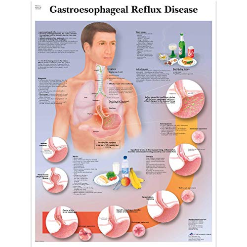 3b-scientific-chart-gastro-sophageale-refluxkrankheit-anatomie-poster-50x67-cm-p image 4