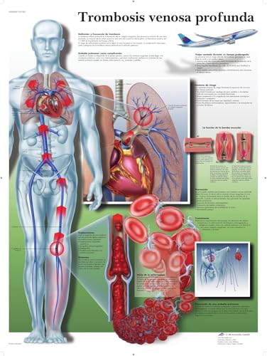 3b-scientific-lehrtafel-tiefe-venenthrombose-anatomie-poster-papier image 2